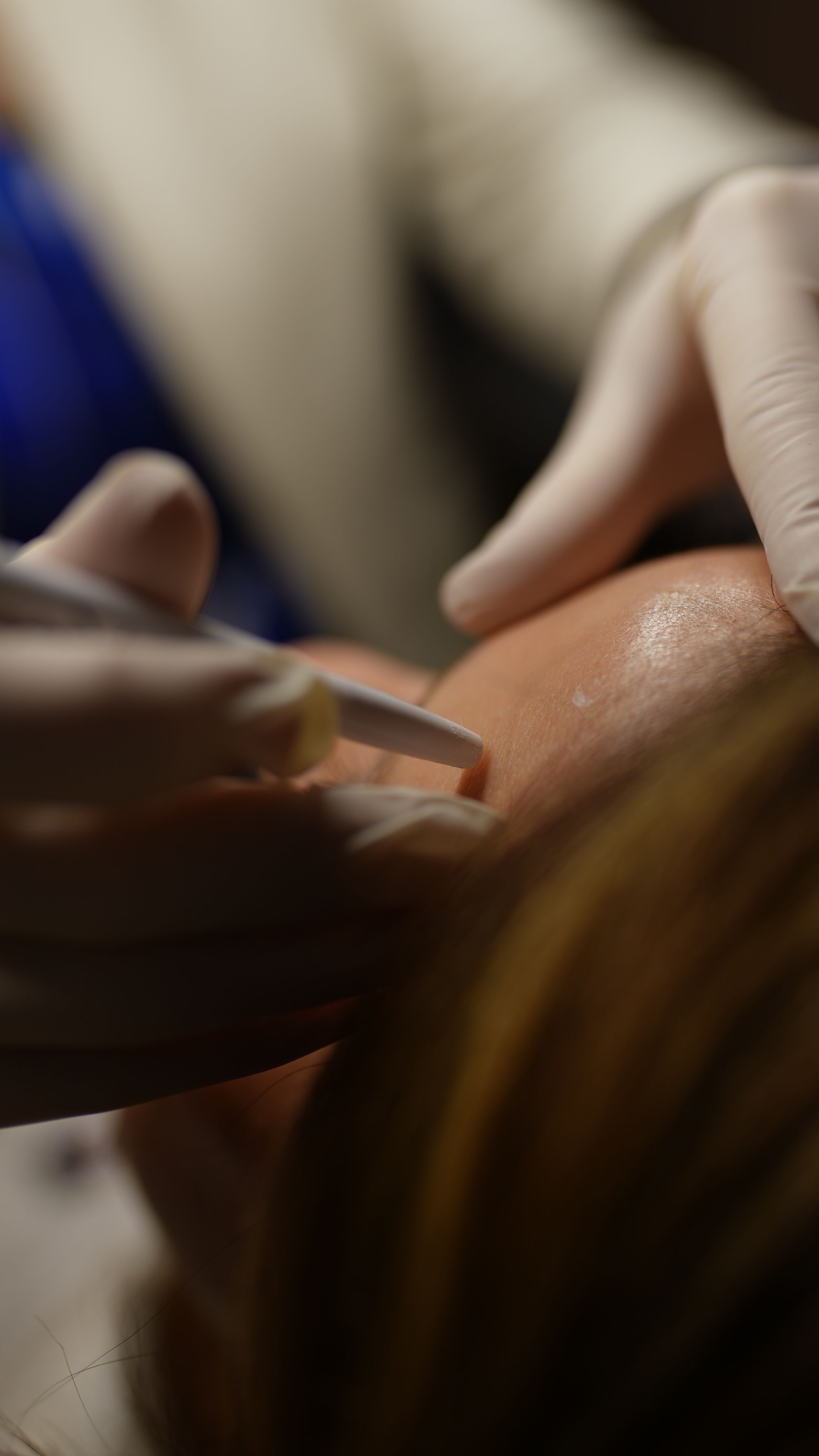 Peelings & Microagulhamento — tratamento estético com Suéllen Yamaoka